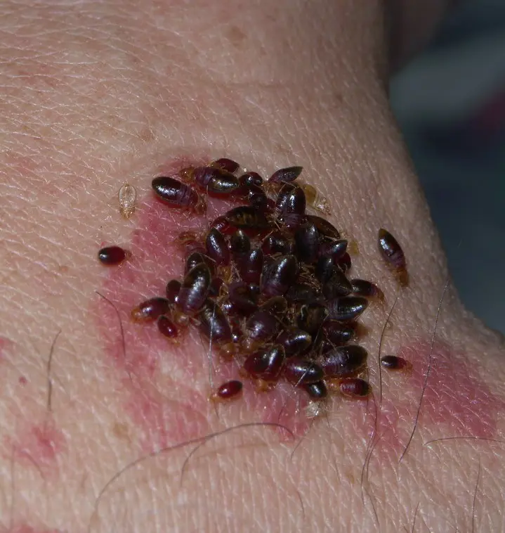 How To Get Rid Of Bed Bugs Permanently